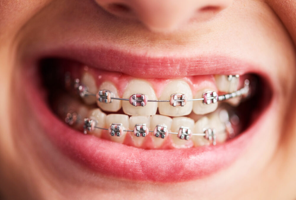 Braces vs. Invisalign: Which Orthodontic Treatment Is Right for You?