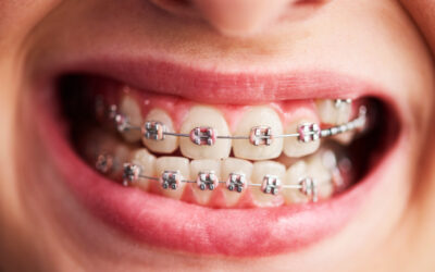 Braces vs. Invisalign: Which Orthodontic Treatment Is Right for You?