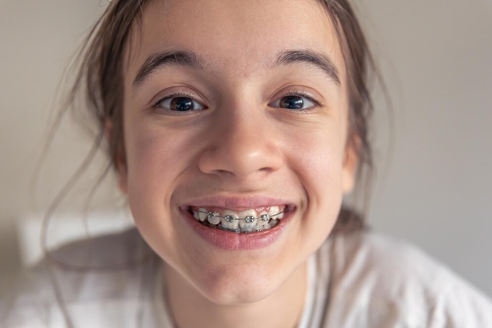 Braces for Teens in Katy, TX: Helping Your Teen Achieve a Confident Smile