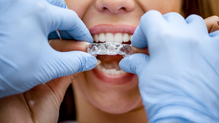 Invisalign in Katy, TX | Clear Braces for Straight Teeth | Affordable Invisalign Treatment