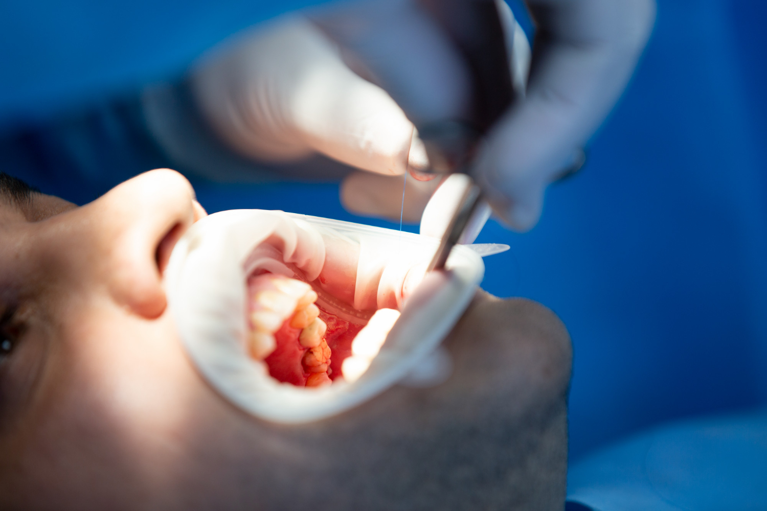 Tooth Replacement in Katy