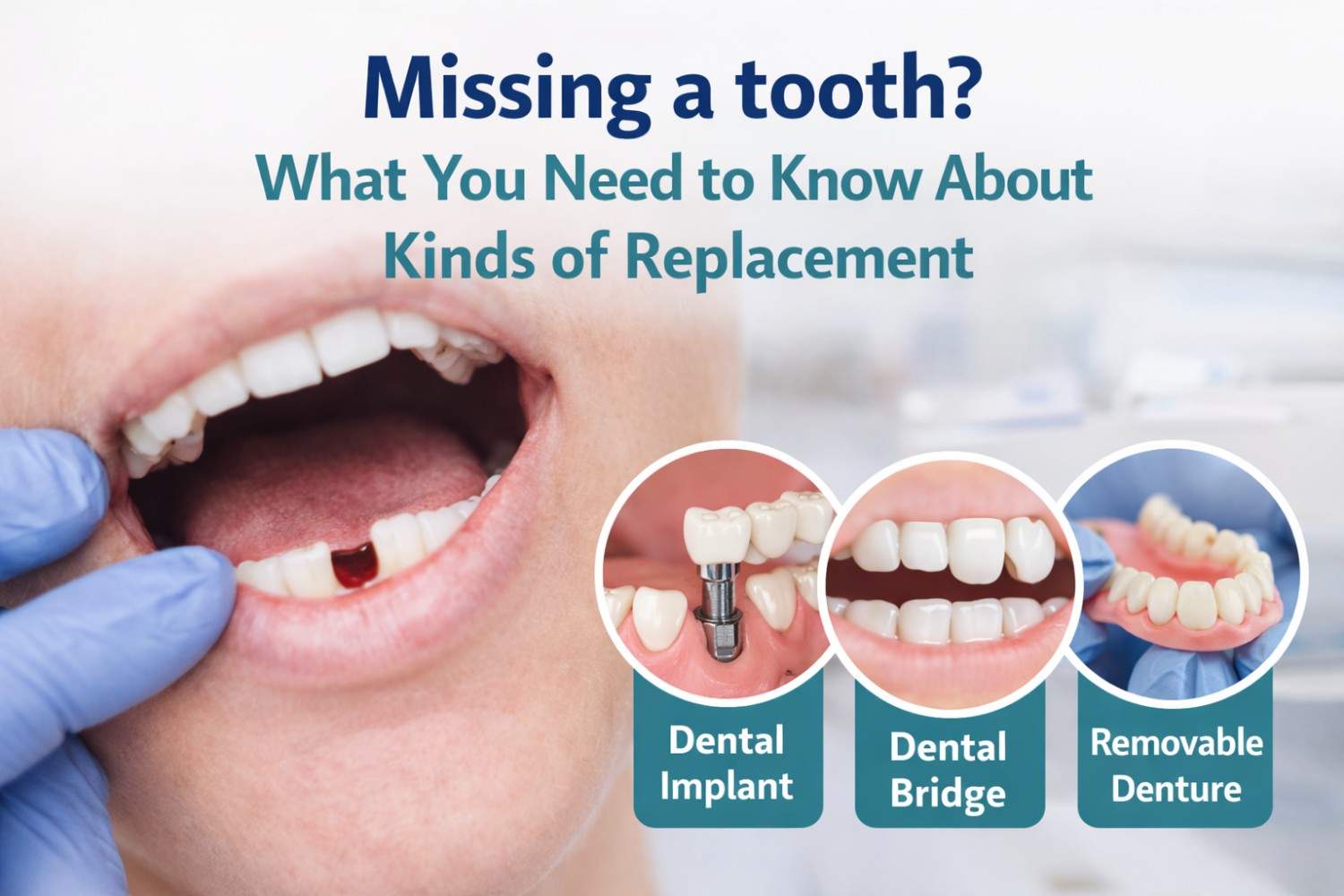 Missing a Tooth? Types of Tooth Replacement Explained