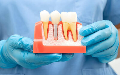 Are Dental Implants the Best Solution for Missing Teeth?